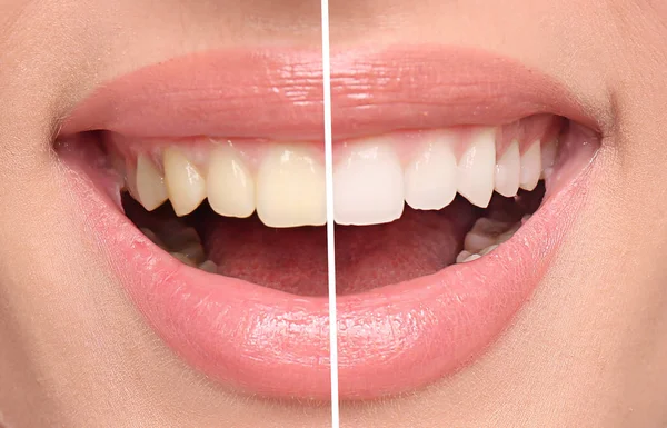 Lächelnde Frau Vor Und Nach Der Zahnaufhellung Nahaufnahme — Stockfoto