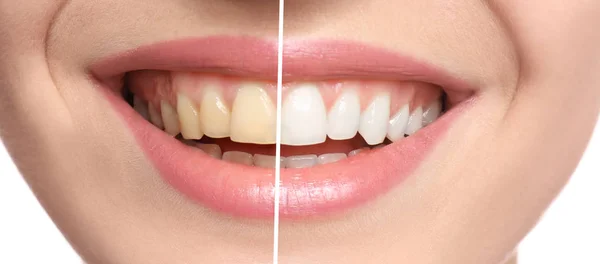 Mujer Sonriente Antes Después Del Procedimiento Blanqueamiento Dientes Primer Plano — Foto de Stock