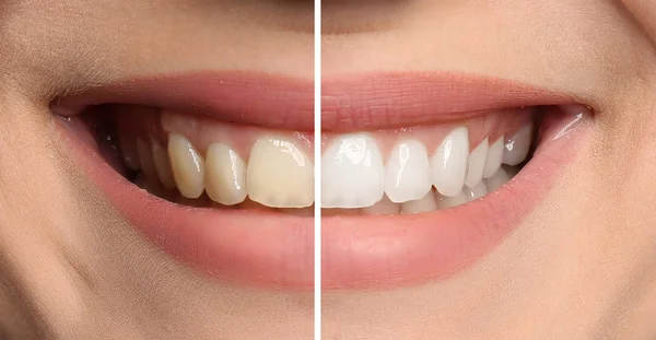 Usmívající Žena Před Bělení Zubů Postup Closeup — Stock fotografie