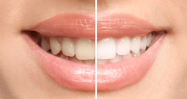 Mujer Sonriente Antes Después Del Procedimiento Blanqueamiento Dientes Primer Plano — Foto de Stock