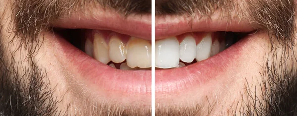 Lächelnder Mann Vor Und Nach Der Zahnaufhellung Nahaufnahme — Stockfoto