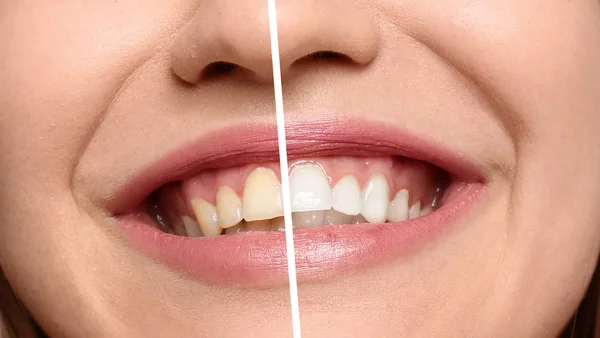 Uśmiechający Się Kobieta Przed Teeth Whitening Procedury Zbliżenie — Zdjęcie stockowe