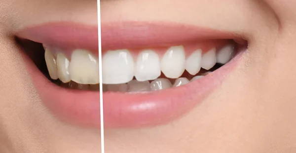 Wanita Tersenyum Sebelum Dan Setelah Prosedur Pemutih Gigi Closeup — Stok Foto