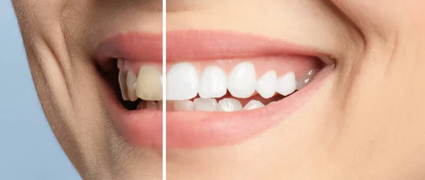 Önce Sonra Yordamı Diş Beyazlatma Gülümseyen Kadın Portre — Stok fotoğraf