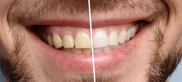 Усміхнений Чоловік Після Процедури Відбілювання Зубів Крупним Планом — стокове фото