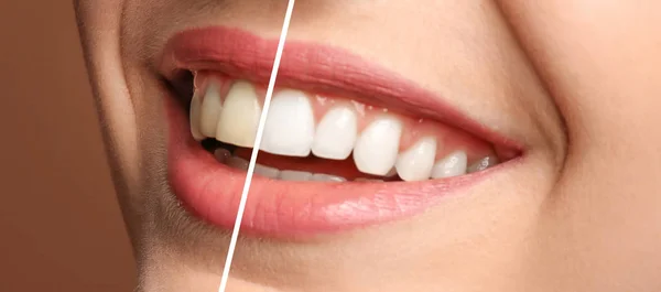 Χαμογελαστό Γυναίκα Πριν Και Μετά Λεύκανση Δοντιών Διαδικασία Κοντινό Πλάνο — Φωτογραφία Αρχείου