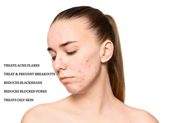 Portrait Young Woman Problem Skin List Acne Cosmetic Effects White — Stock Photo, Image