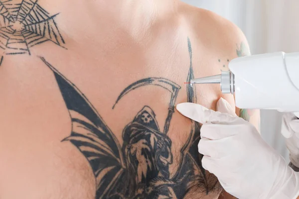 Hombre Sometido Procedimiento Eliminación Tatuajes Láser Salón Primer Plano — Foto de Stock