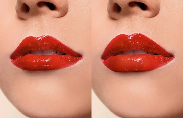 Frau Vor Und Nach Der Lippenvergrößerung Nahaufnahme Schönheitschirurgie — Stockfoto