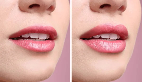 Woman Lips Augmentation Procedure Closeup Cosmetic Surgery — Stock Photo, Image