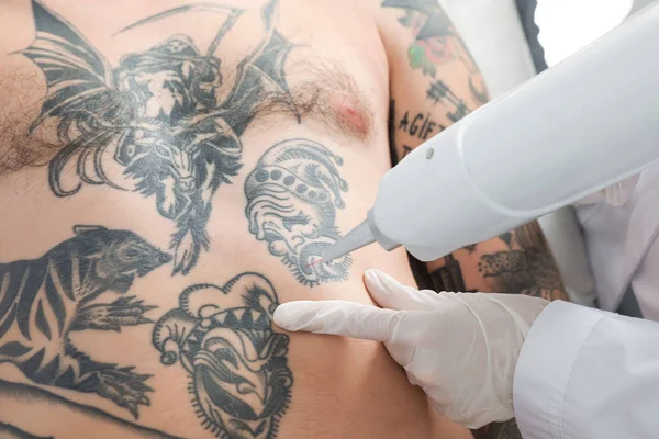 Hombre Sometido Procedimiento Eliminación Tatuajes Láser Salón Primer Plano — Foto de Stock