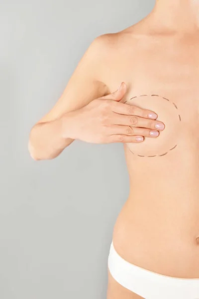 灰色背景に クローズ アップ整形手術操作のための胸マークを持つ若い女性 — ストック写真