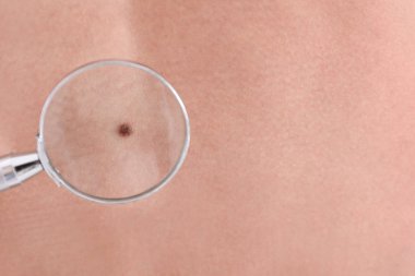 Büyüteç Camı, closeup görünümü altında hasta Doğum izine benzer. Dermatolog ziyaret