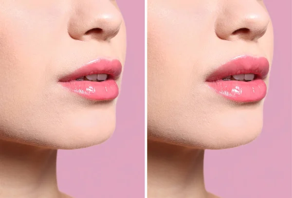 Woman before and after lips augmentation procedure on light background, closeup