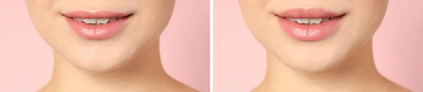 Woman Lips Augmentation Procedure Light Background Closeup — Stock Photo, Image