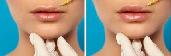 Cosmetologist making lips injection on color background, closeup. Woman before and after augmentation procedure