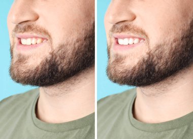 Adam önce ve sonra yordamı, diş beyazlatma gülümsüyor portre