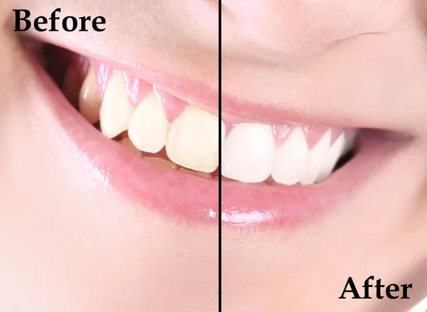 Посміхаючись Молода Жінка Після Процедури Відбілювання Зубів Крупним Планом — стокове фото