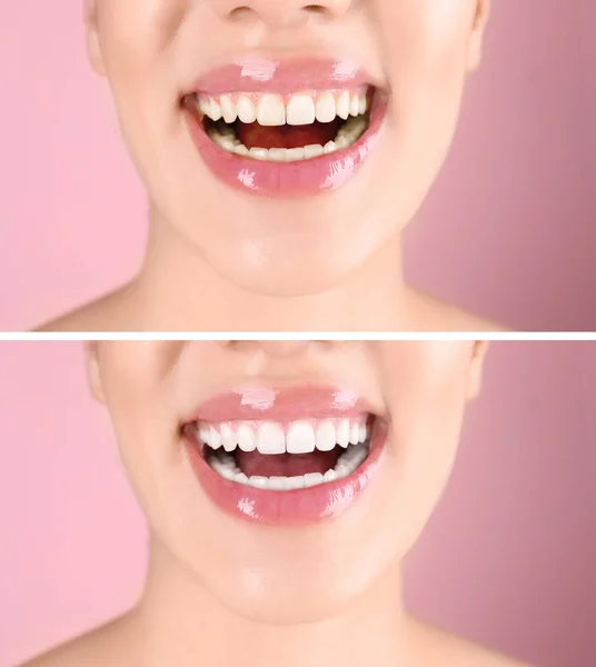 Mujer Joven Sonriente Antes Después Del Procedimiento Blanqueamiento Dientes Fondo — Foto de Stock