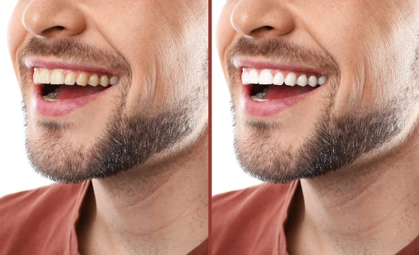 Hombre Sonriente Antes Después Del Procedimiento Blanqueamiento Dientes Primer Plano — Foto de Stock