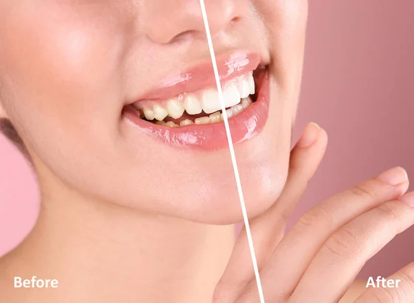 Χαμογελώντας Νεαρή Γυναίκα Πριν Και Μετά Λεύκανση Δοντιών Διαδικασία Έγχρωμο — Φωτογραφία Αρχείου