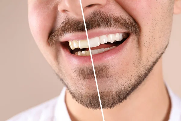 Uomo Sorridente Prima Dopo Procedura Sbiancamento Dei Denti Sfondo Colore — Foto Stock