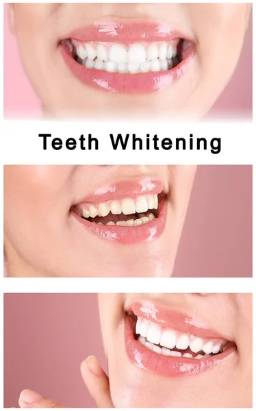 Smiling Young Woman Teeth Whitening Procedure Color Background Closeup — Stock Photo, Image