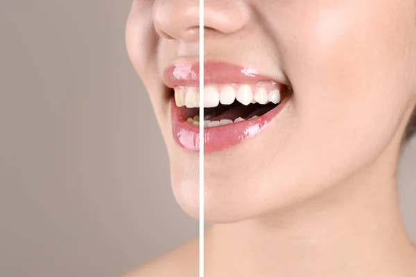 Mujer Joven Sonriente Antes Después Del Procedimiento Blanqueamiento Dientes Fondo — Foto de Stock