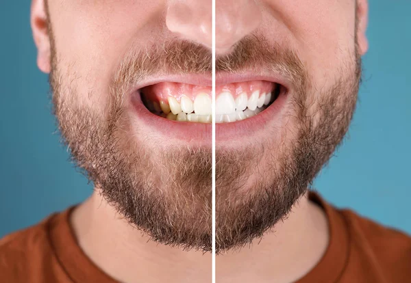 Ler Man Före Och Efter Tandblekning Förfarande Färg Bakgrunden Närbild — Stockfoto