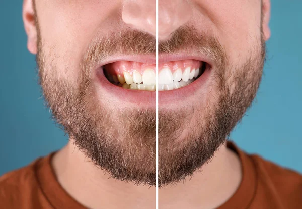 Hombre Sonriente Antes Después Del Procedimiento Blanqueamiento Dientes Fondo Color — Foto de Stock