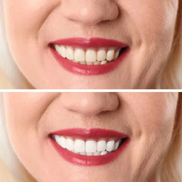 Mujer Madura Sonriente Antes Después Del Procedimiento Blanqueamiento Dientes Primer — Foto de Stock