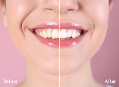 Gülümseyen genç kadın önce ve sonra renk arka plan, closeup ameliyat diş beyazlatma