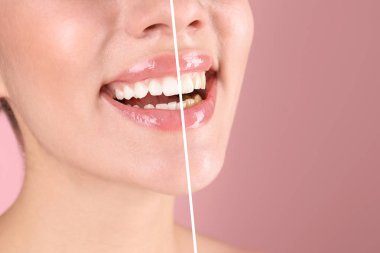 Gülümseyen genç kadın önce ve sonra renk arka plan, closeup ameliyat diş beyazlatma