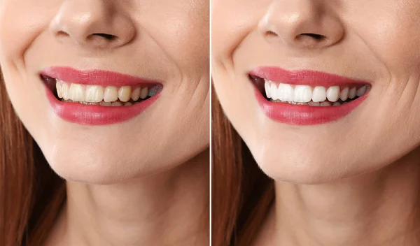 Mujer Sonriente Antes Después Del Procedimiento Blanqueamiento Dientes Primer Plano — Foto de Stock