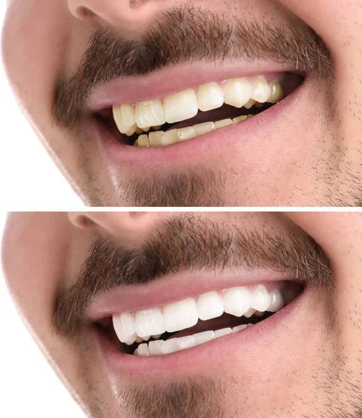 Hombre Sonriente Antes Después Del Procedimiento Blanqueamiento Dientes Primer Plano — Foto de Stock