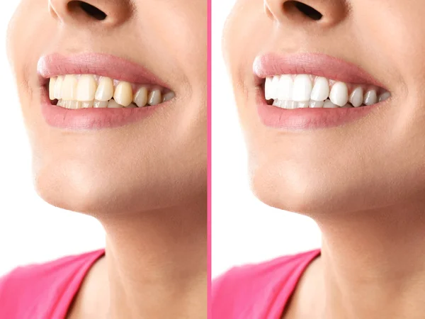Lächelnde Frau Vor Und Nach Der Zahnaufhellung Auf Farbigem Hintergrund — Stockfoto
