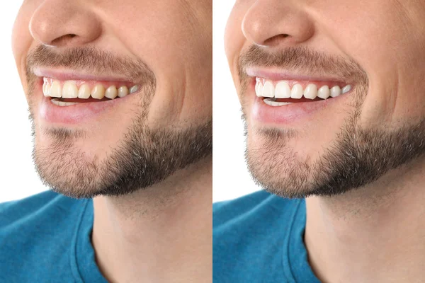 Hombre Sonriente Antes Después Del Procedimiento Blanqueamiento Dientes Primer Plano — Foto de Stock