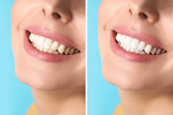Donna Sorridente Prima Dopo Procedura Sbiancamento Dei Denti Sfondo Colore — Foto Stock
