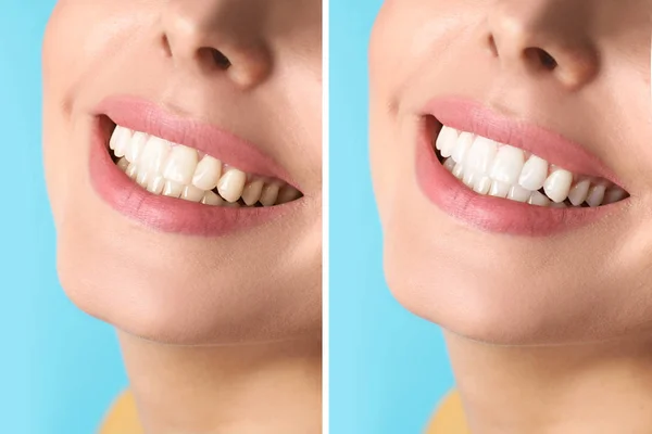 Mujer Sonriente Antes Después Del Procedimiento Blanqueamiento Dientes Fondo Color — Foto de Stock