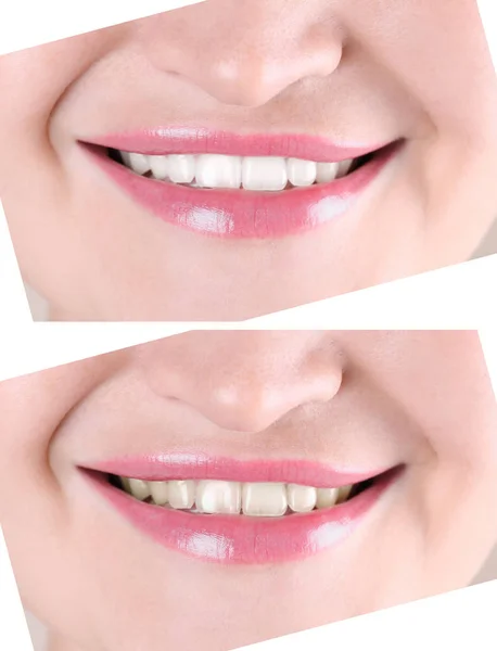 Χαμογελαστά Νεαρή Γυναίκα Πριν Και Μετά Λεύκανση Δοντιών Διαδικασία Κοντινό — Φωτογραφία Αρχείου