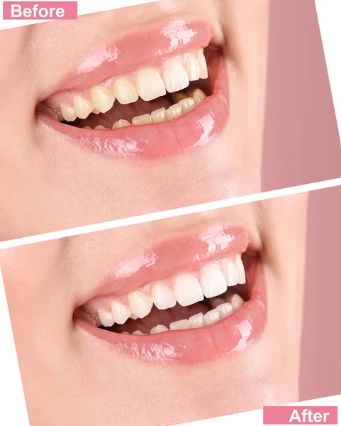 Uśmiechający Się Młoda Kobieta Przed Teeth Whitening Procedury Kolor Tła — Zdjęcie stockowe