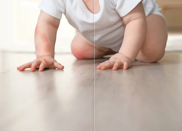Cute Little Baby Allergy Treatment Crawling Floor Indoors Closeup — Stock Photo, Image
