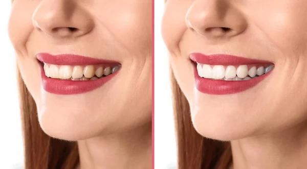 Mulher Sorridente Antes Depois Dos Dentes Branqueamento Procedimento Close — Fotografia de Stock