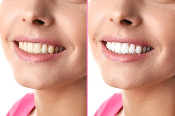 Smiling Woman Teeth Whitening Procedure Closeup — Stock Photo, Image