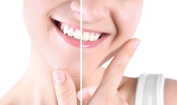 Lächelnde Junge Frau Vor Und Nach Der Zahnaufhellung Auf Weißem — Stockfoto