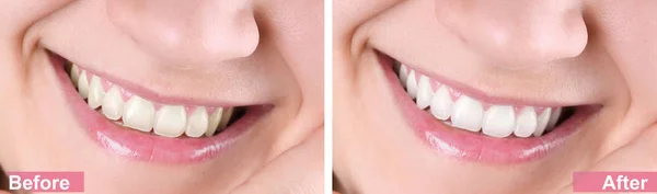 Leende Ung Kvinna Före Och Efter Tandblekning Förfarande Närbild — Stockfoto