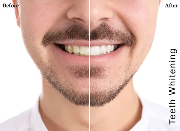 Ler Man Före Och Efter Tandblekning Förfarande Ljus Bakgrund Närbild — Stockfoto