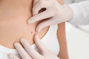 Dermatolog klinikte hastanın doğum lekesini inceliyor.