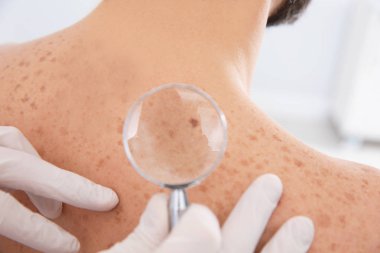 Dermatolog, klinikte büyüteçle hastanın doğum lekesini inceliyor.