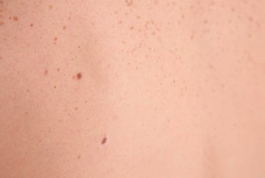 Doğum lekeleri, closeup görünümü olan kişi. Dermatolog ziyaret etmek için zaman